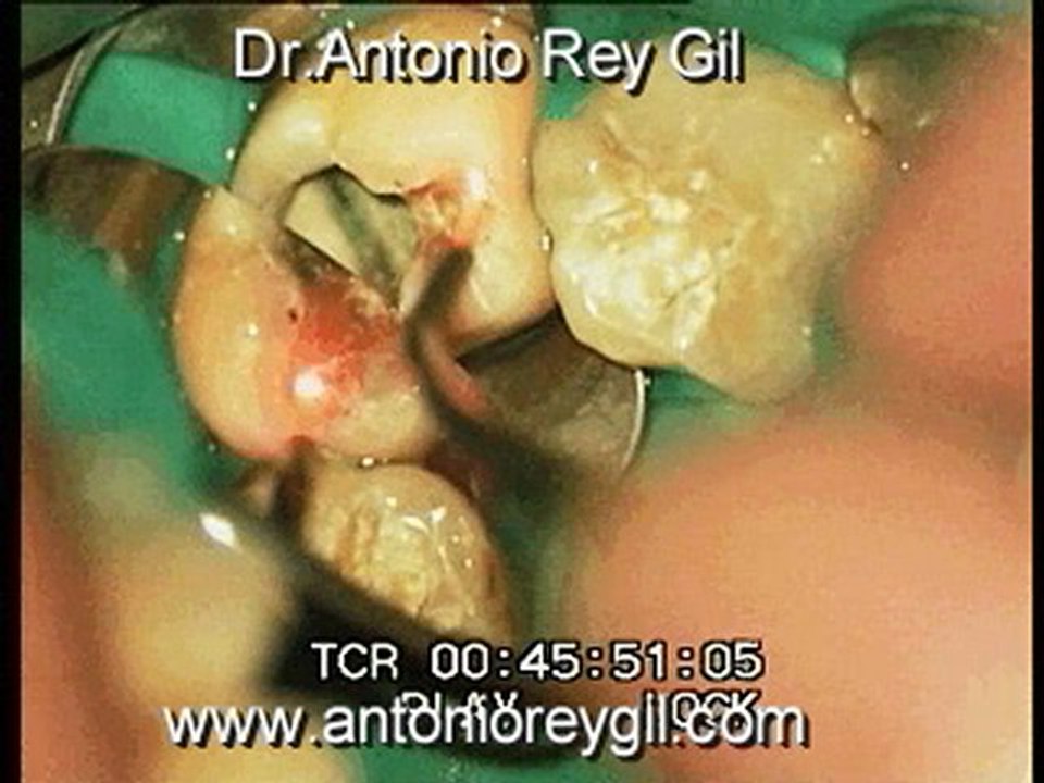 2.Video .Lásers Dental .Dr.ANTONIO REY GIL (GROUP MACIEL)