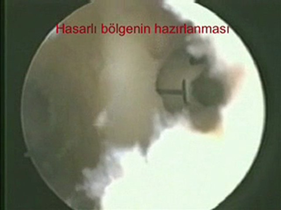 kikirdak nakli