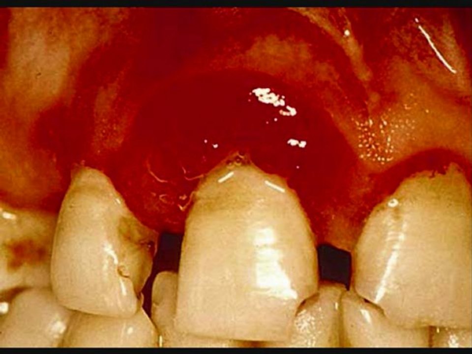 Bleed Gums Stop Bleeding Gum Treat Gums Bleeding Stop Bleed