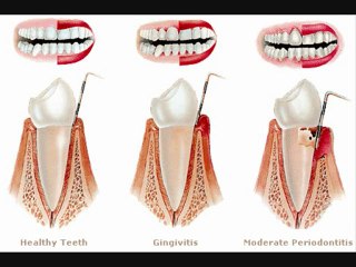 Stop Bleeding Gums Cure Bleedings Gum Heal Bleed Red Swollen