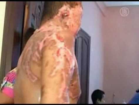 Acid Attacks Rise in Cambodia