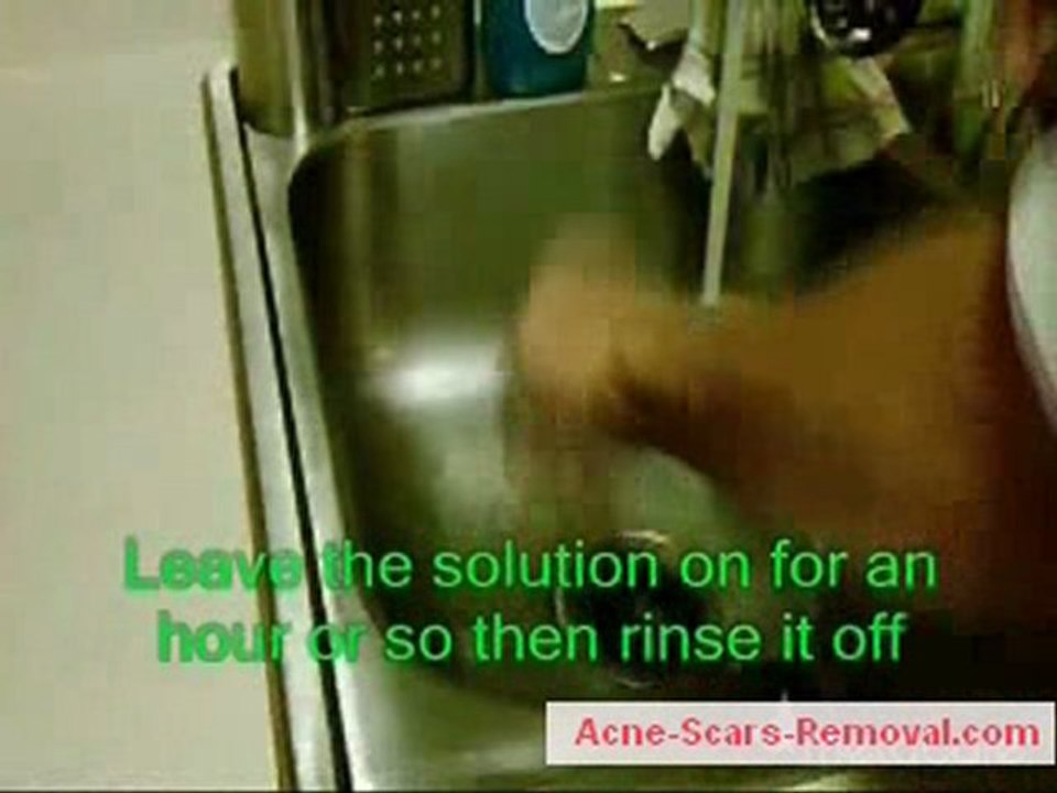 Clear ACNE instantly with banking soda, very easy to do