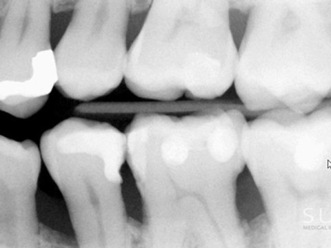 Intraoral Case Studies Imaged with Suni Sensors: Chapter 1