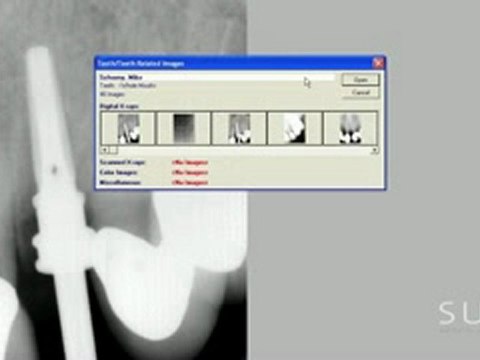 Intraoral Case Studies Imaged with Suni Sensors: Chapter 3