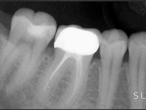 Intraoral Case Studies Imaged with Suni Sensors: Chapter 5