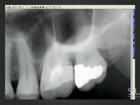 Intraoral Case Studies Imaged with Suni Sensors