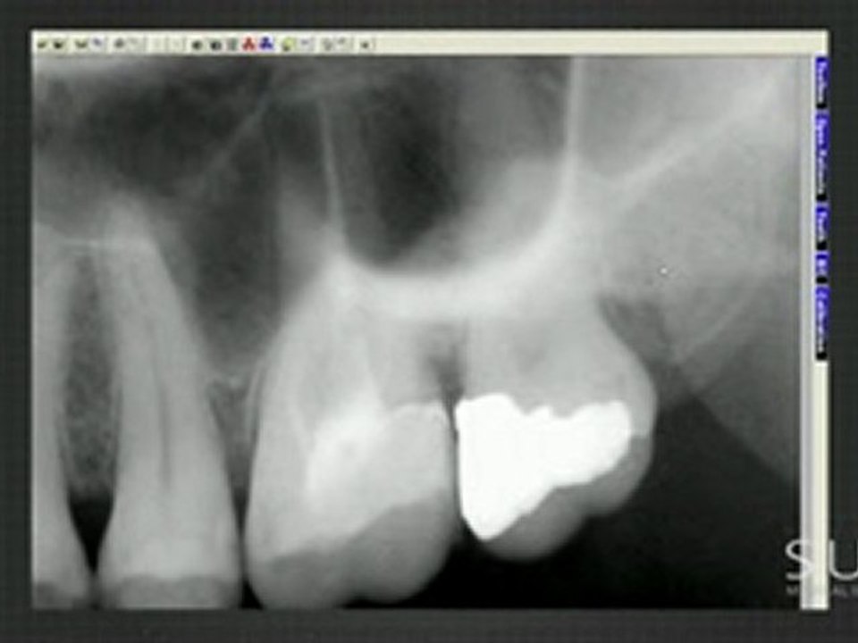 Intraoral Case Studies Imaged with Suni Sensors