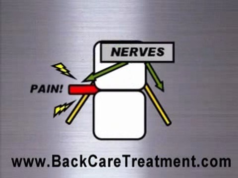 Spinal decompression in San Diego info video