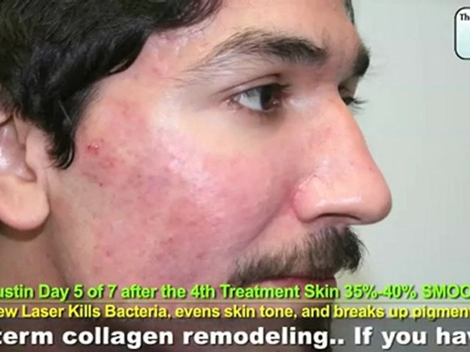 Texas Acne Scar Removal at South Coast MedSpa