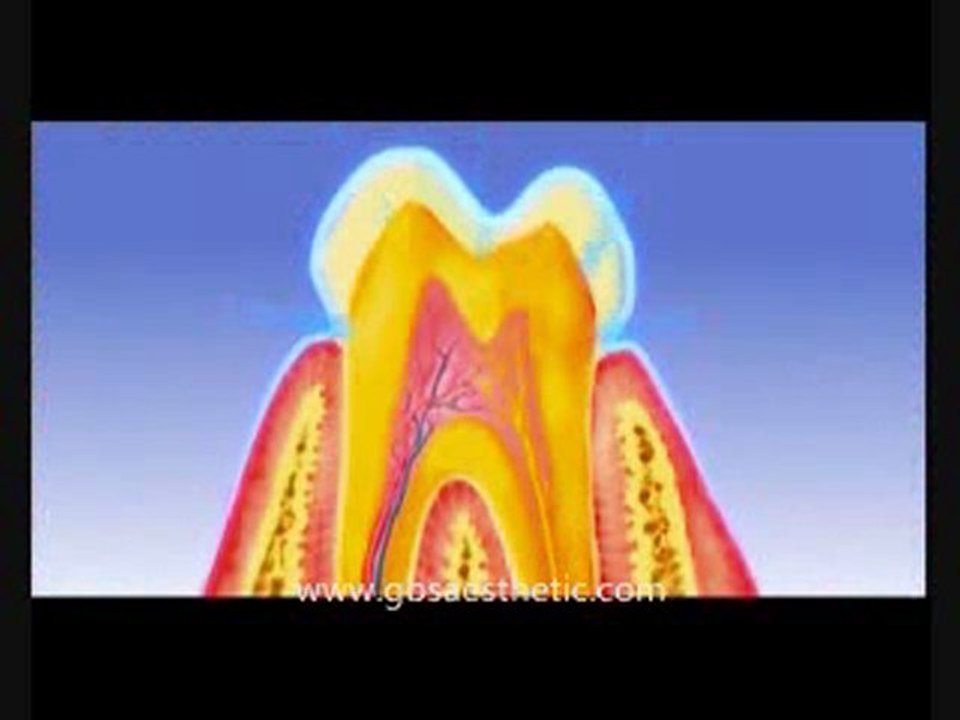 C-Blue Light Teeth whitening( teeth bleaching)System introdu