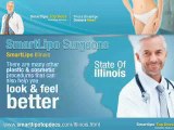 Smart Lipo Top Docs Illinois