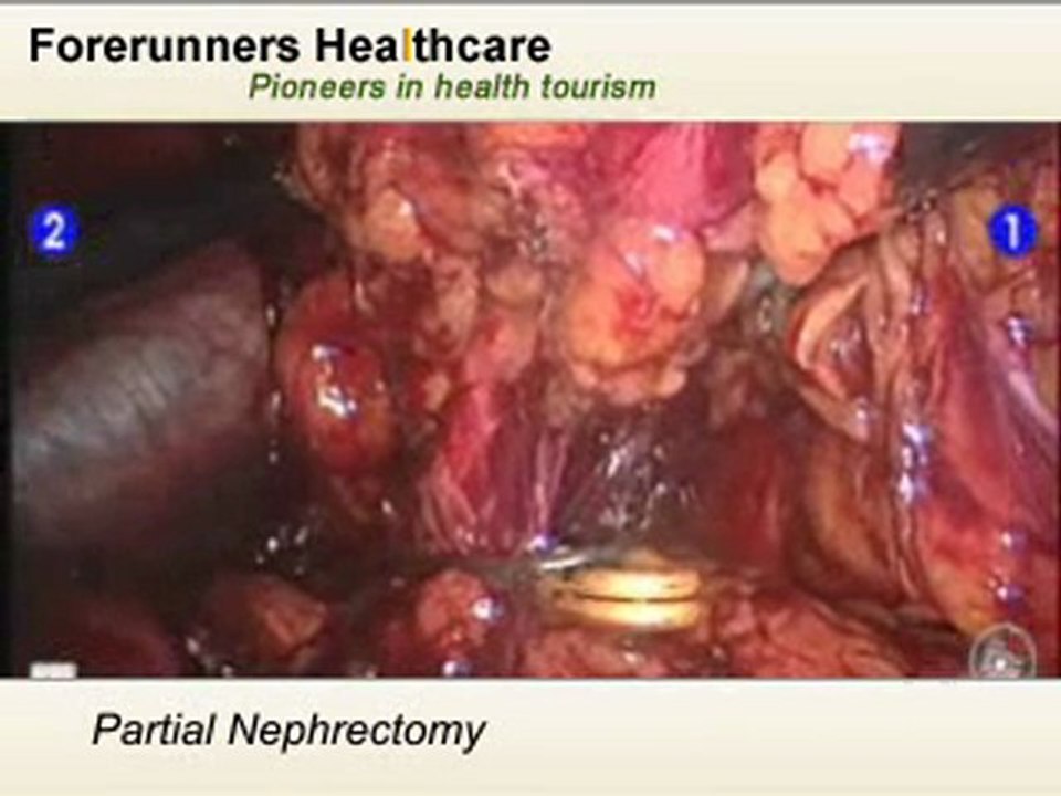 Get Renal cell carcinoma Treatment at various hospitals in I