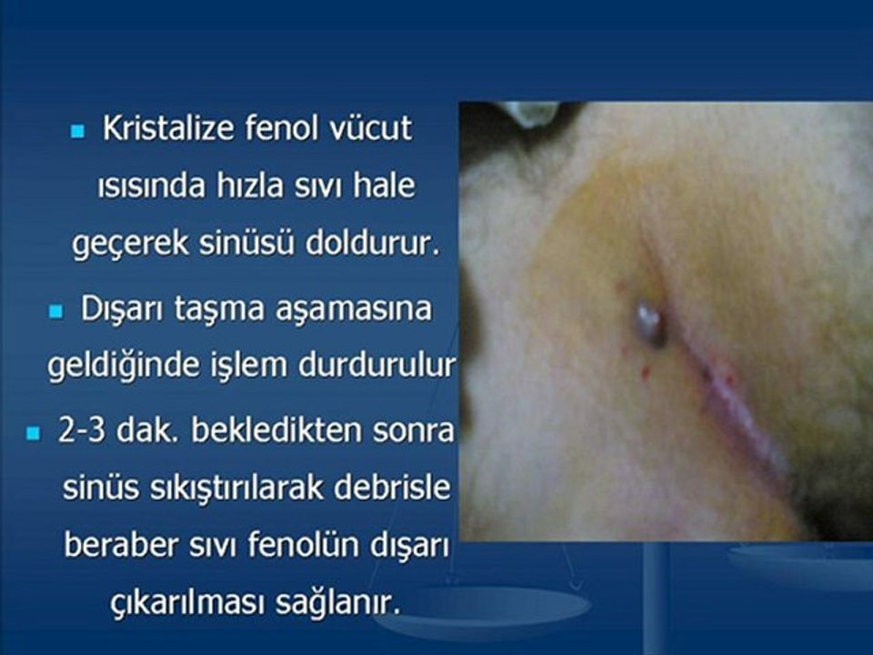 FENOL TEDAVİSİ