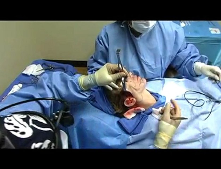 Short Recovery following Face Lift with Fat Transfer