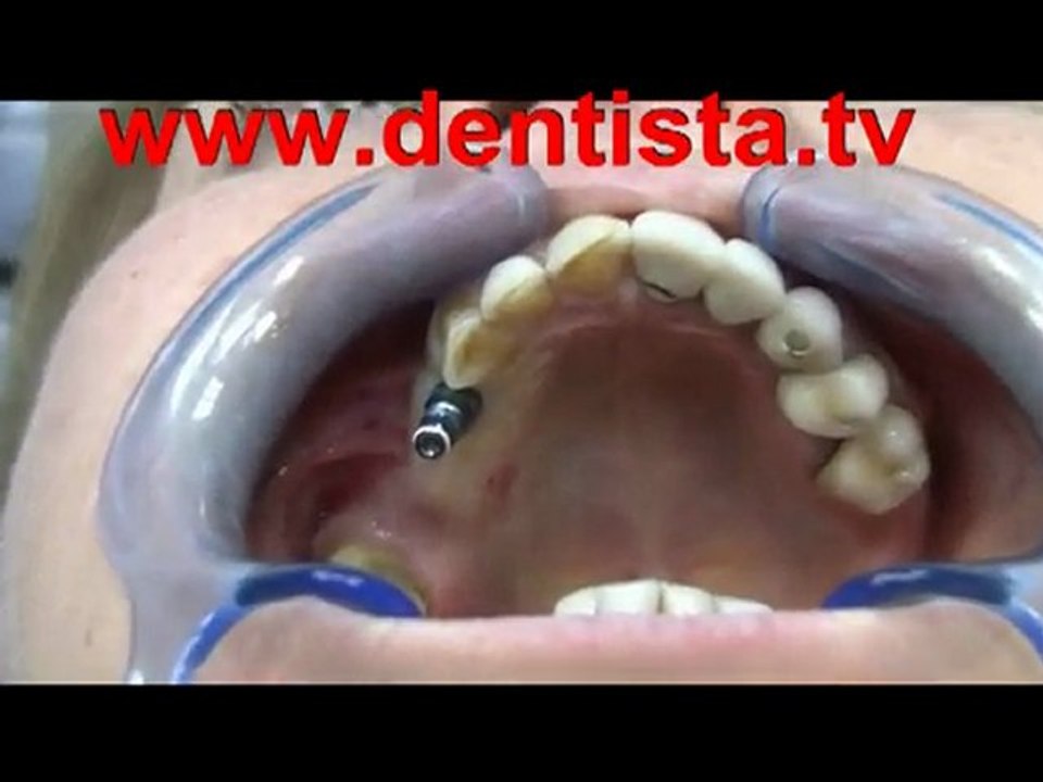 DENTISTA - IMPLANTOLOGIA