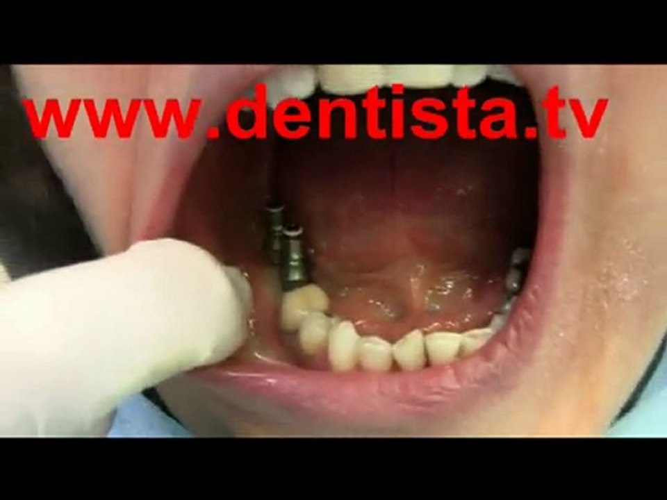 DENTISTA IMPLANTOLOGIA DENTISTA PREZZI