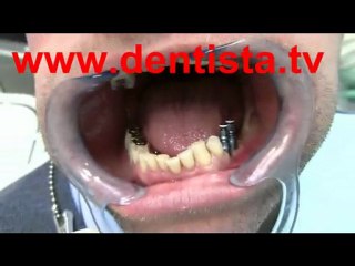 IMPLANTOLOGIA DENTISTA