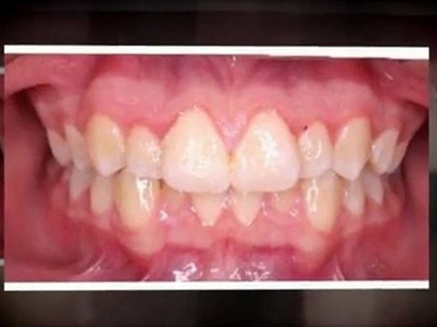 Fort Collins Orthodontist: What Braces Will Do For You!