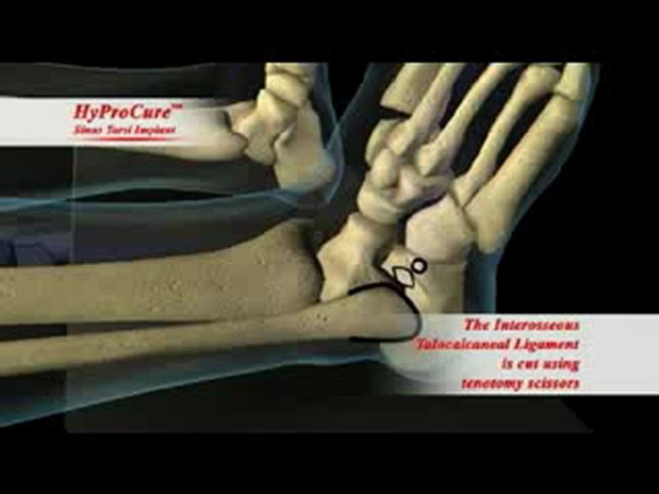 hyprocure animasyon