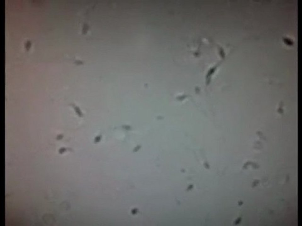 Nagyon rossz spermakép nagy nagyításban. www.andrologiarp.hu