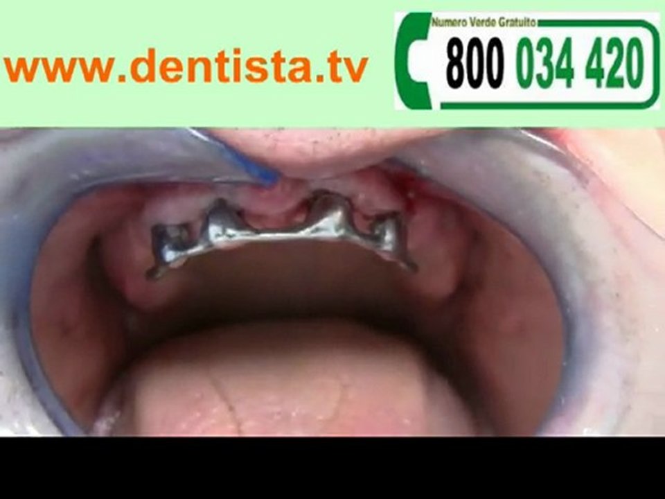 DENTISTA DENTI FISSI IMPLANTOLOGIA DENTALE