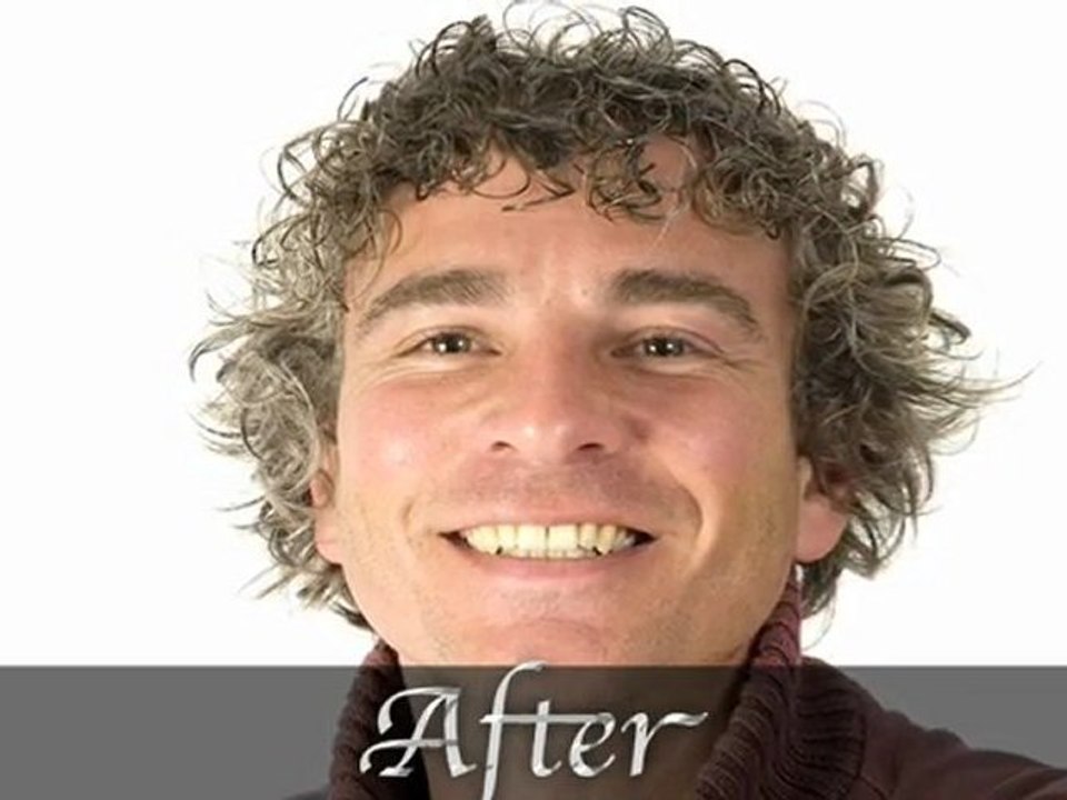 Hair Loss Replacement System Orange County California