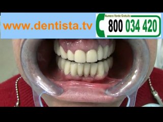 DENTI FISSI IMPIANTI DENTARI