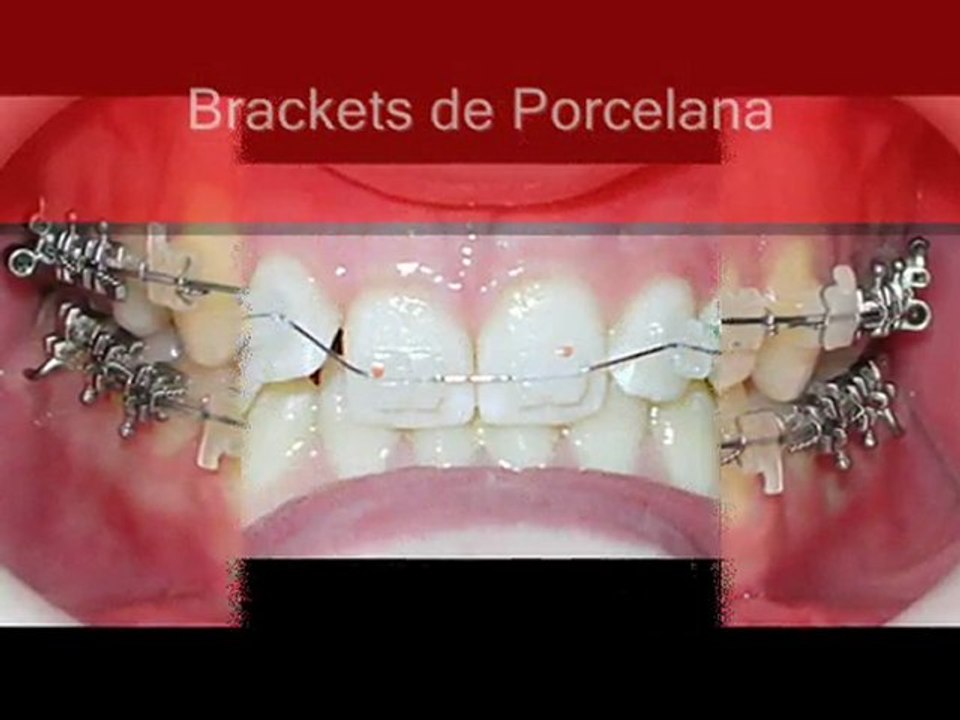 Tipos de Brackets Esteticos Metalicos Damon Porcelana Zafiro Vídeo