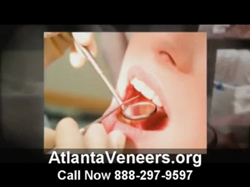 Atlanta Veneers