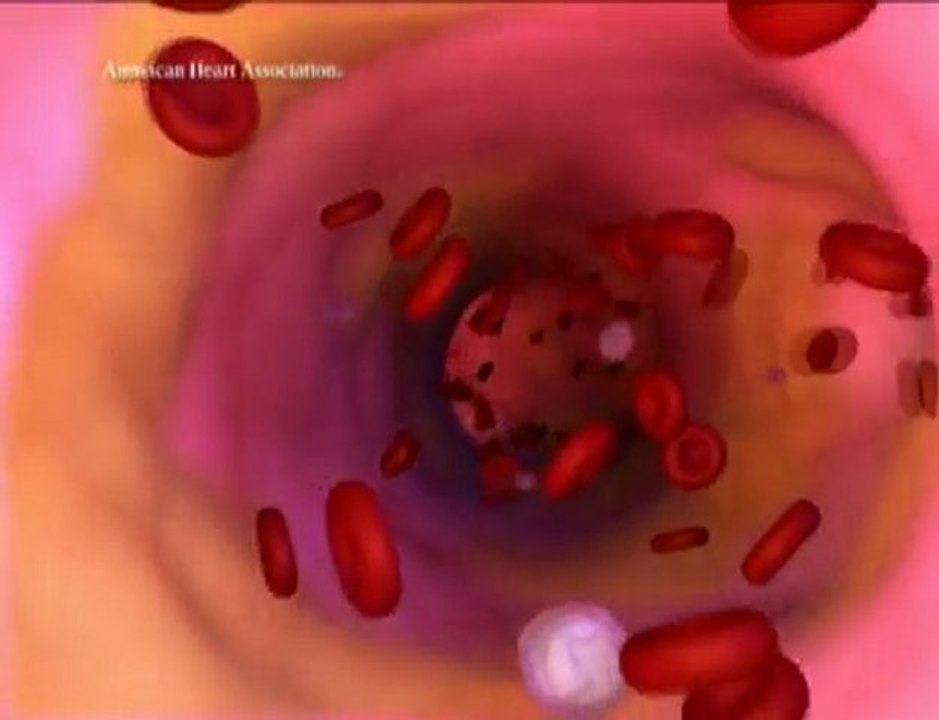 Neues Medikament schützt vor Herzinfarkten