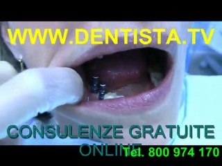 IMPIANTI DENTALI IN TITANIO