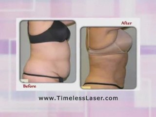 SmartLipo Florida