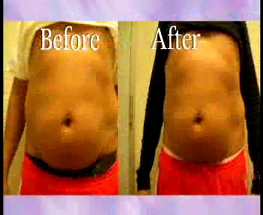 Westwood Lipo Laser Liposuction Treatments