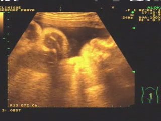 Arthur 36 semaines et 3 jours