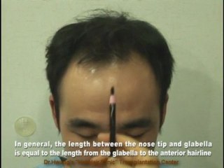 Hair Transplantation procedure
