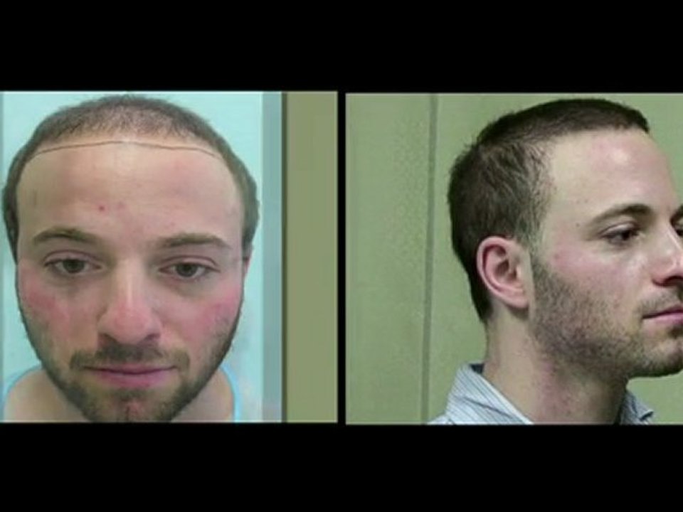 FUE Hair Transplants with Hybrid Body Hair Transplant