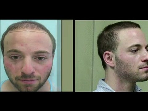 FUE Hair Transplants with Hybrid Body Hair Transplant
