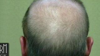 My severe baldness cured with body hair_s