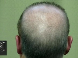 My severe baldness cured with body hair_s