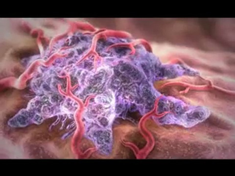 Рак простаты, лечение рака простаты радиохирургия Кибер Нож