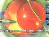 Acrysof Toric : Positionnement  Dr P.Levy Montpellier