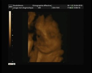 2 ème épisode echo 4 D