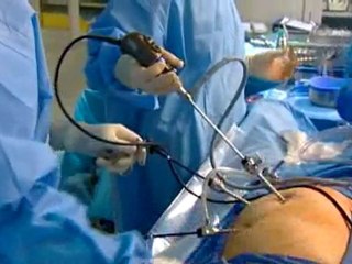 Minimally Invasive Colon Cancer Treatment