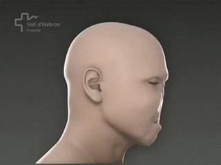 Primer trasplante total de cara en el mundo