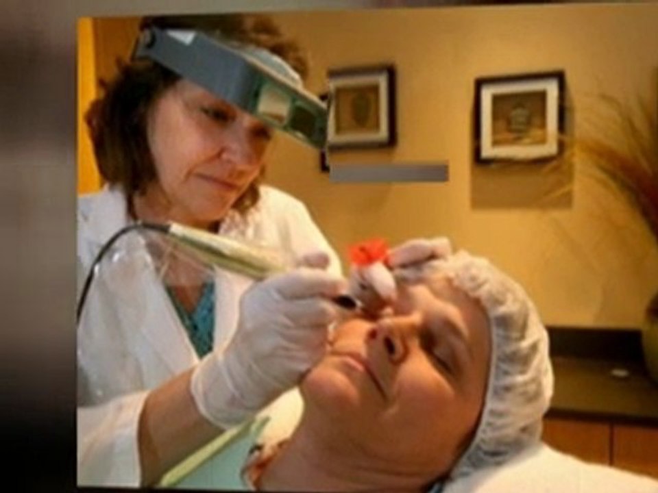 Spider Veins Removal - Get Rid of Spider Veins