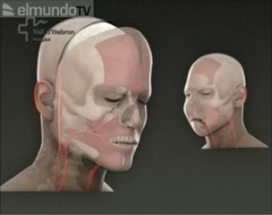 Trapianto totale di viso