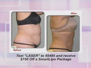 SmartLipo Florida