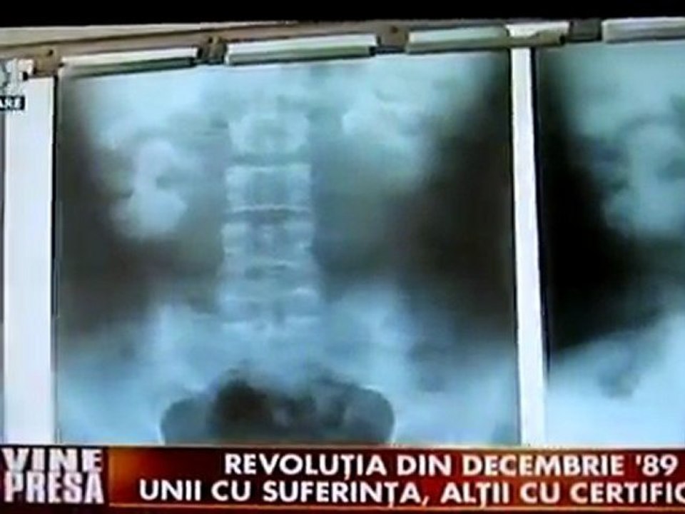 Viorel Dumitrache, impuscat in 1989, si azi in spital