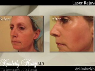 Laser Skin Resurfacing in San Francisco Bay Area