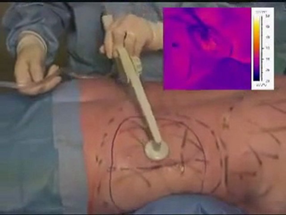 BodyTite Liposuction Manhattan, BodyTite New York City